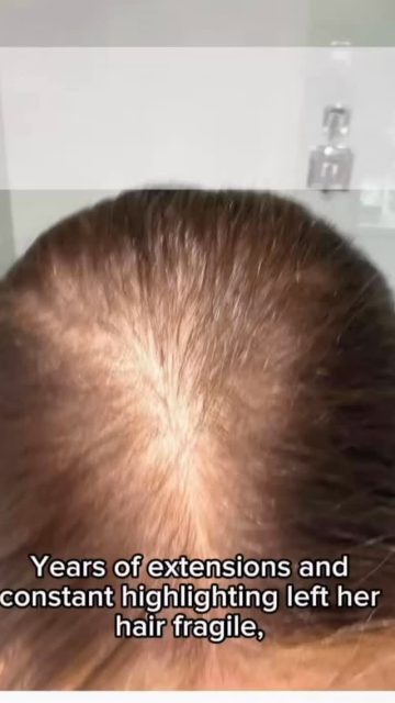 #wiglife #wigtips #alopeciaawareness #hairlossjourney Years of extensions and constant highlighting left her hair fragile, thin, and exhausted.
When she came to me for hair loss support, one of the first things I recommended was giving her natural hair a true break — removing the extensions, stopping the chemical processing, and allowing her scalp and hair to recover.
She was hesitant at first.
Like many women, she was afraid a wig would look “wiggy.”
Together, we chose a wig from my collection and customized it specifically for her:
• darker roots for depth and realism
• soft lowlights for dimension
• personalized hairline customization
• a haircut designed to flatter her features and feel natural to her lifestyle
And… wow. The transformation was beautiful.
Not only did she regain confidence immediately, but after just 3 months of protecting her natural hair, she began seeing signs of recovery and healthier growth.
Sometimes healing starts when we stop fighting our hair and start protecting it.
Trust the process. ✨
At Crowning Confidence MD, I offer hair loss support, wig recommendations, and advanced wig customization designed to help you feel confident